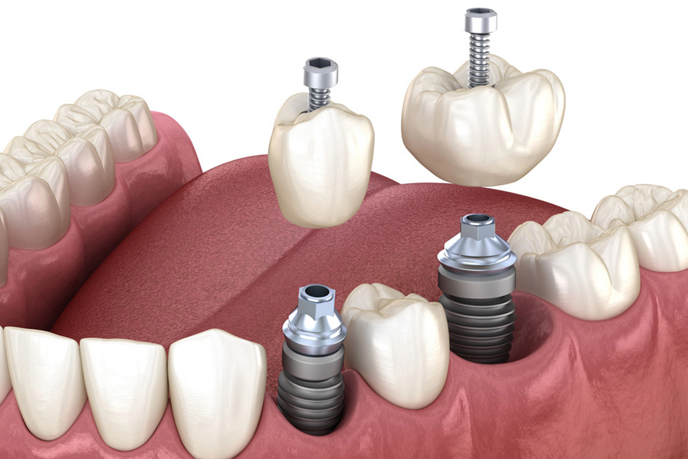Can A General Dentist Handle Dental Implants?