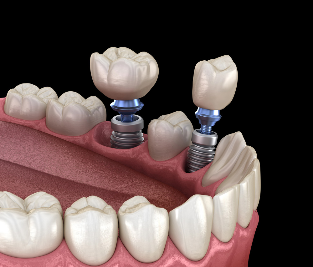 Are Dental Implants Considered Cosmetic Or A Functional Solution?