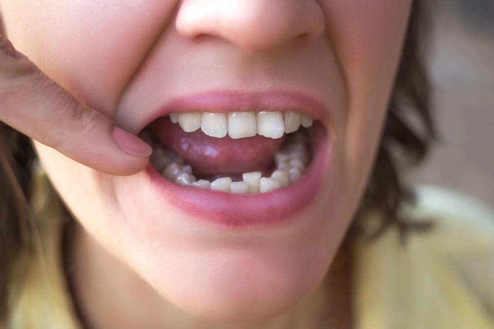 Can Invisalign Fix Crowding? Your Questions Answered