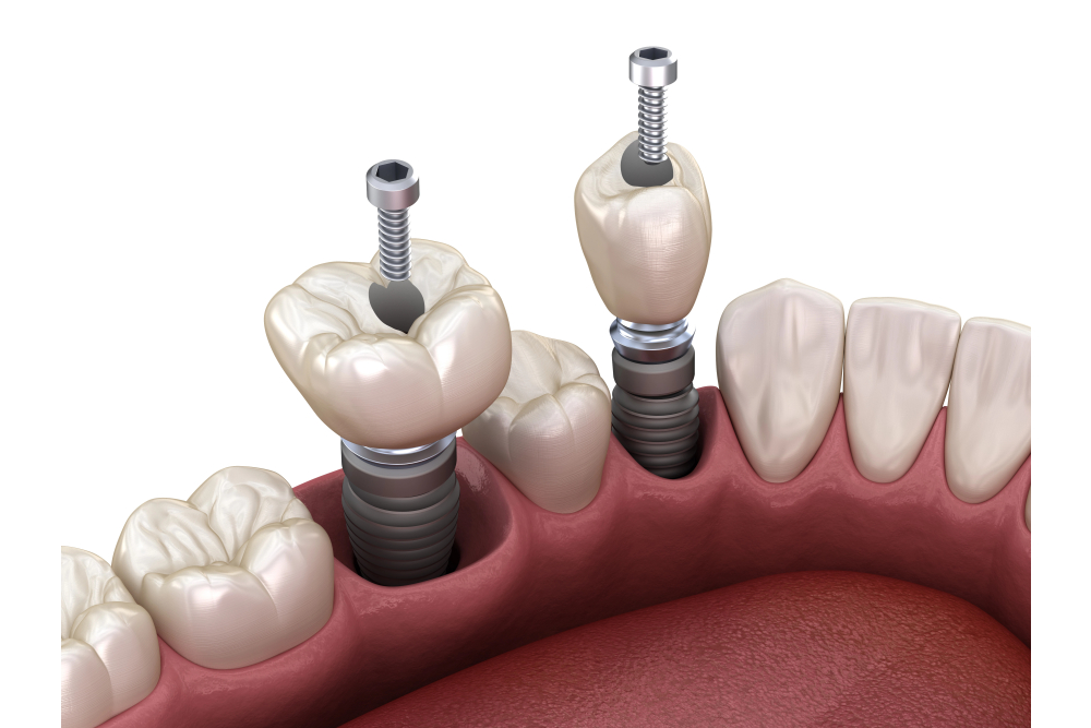 5 Common Restorative Dental Procedures Explained
