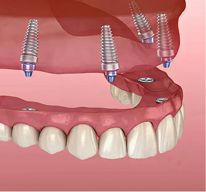 Major-Restorative-Dentist-Image-All-of-4-Implants