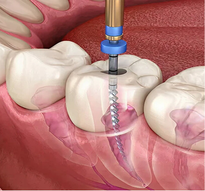 Major-Restorative-Dentist-Image-Root-Canals