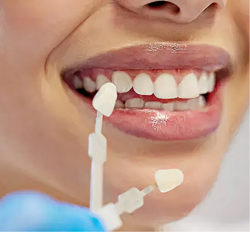 Minor-Restorative-Dental-Image-Veneers