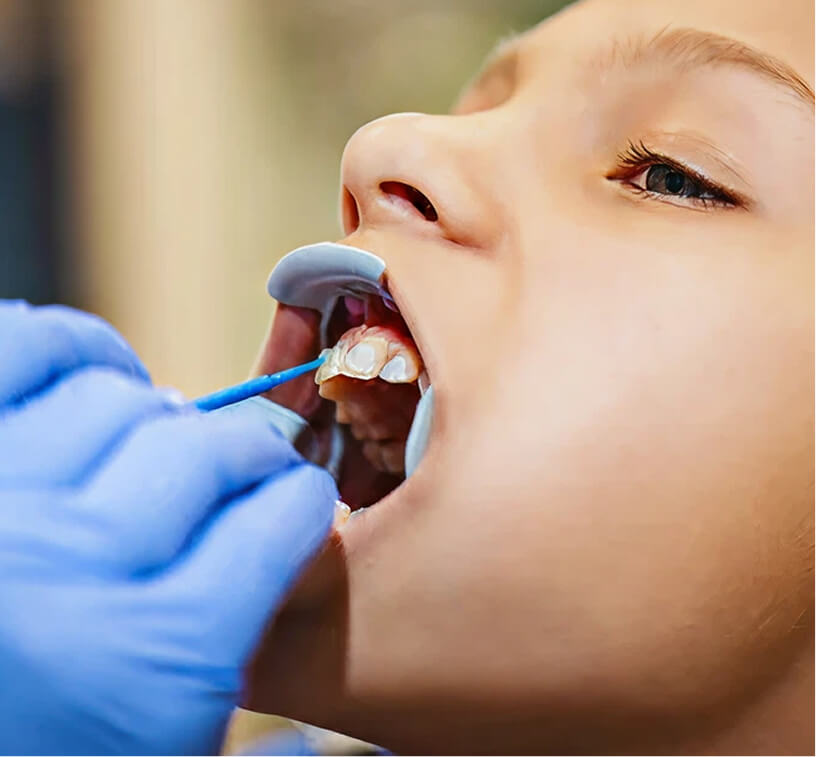 Minor-Restorative-Dental-Image-dental-Bonding