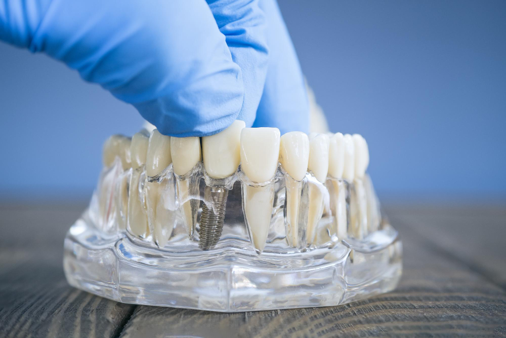 How Long Does A Dental Implant Procedure Take?