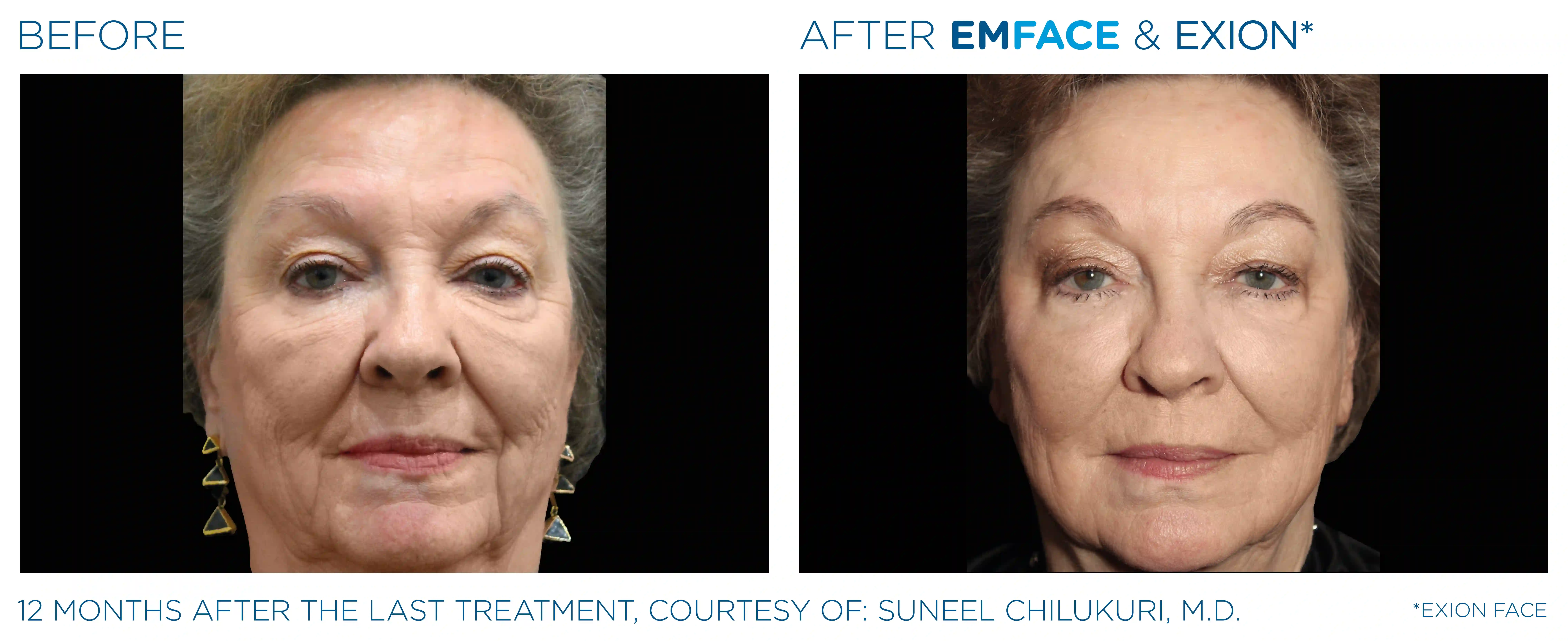 Emface_Exion_PIC_Ba-card-face-female-001_ENUS100