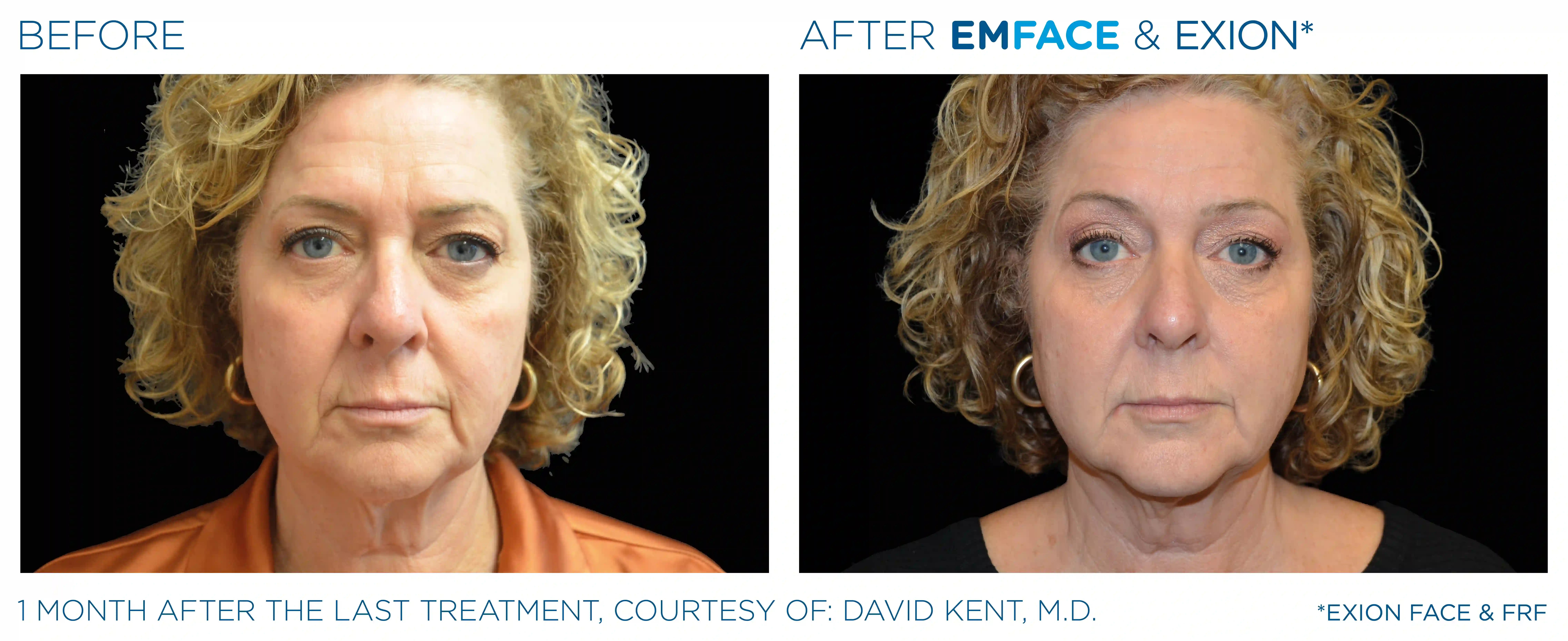 Emface_Exion_PIC_Ba-card-face-female-011_ENUS100