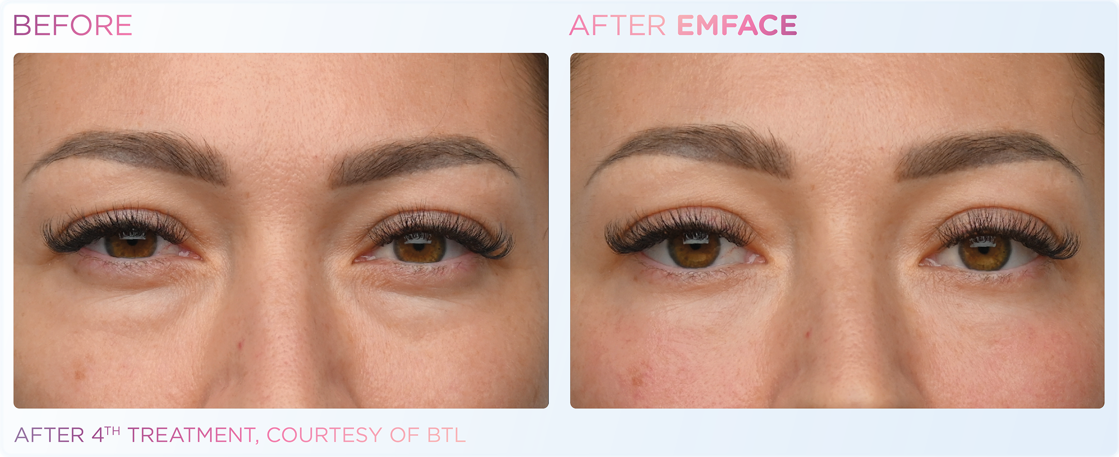 Emface_PIC_Ba-card-female-eyes-159_ENUS100