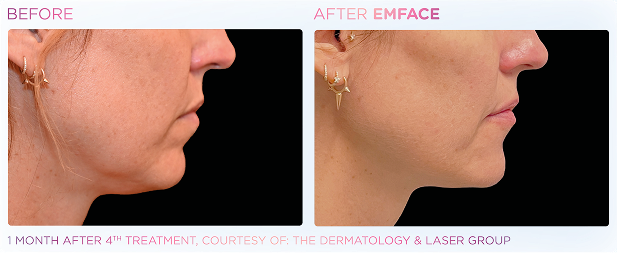 Emface_PIC_Ba-card-female-jawline-067_ENUS100 2