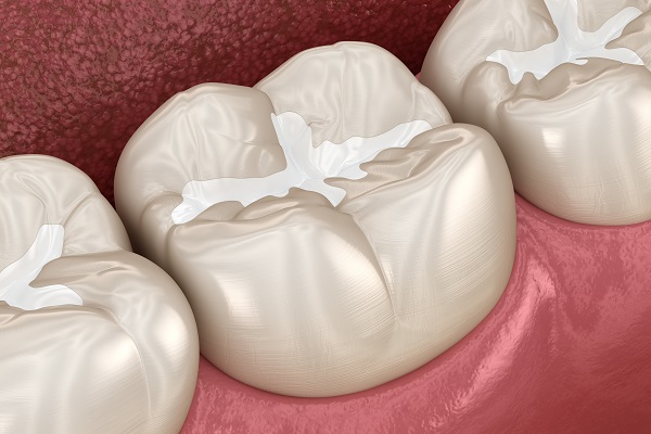 Reasons To Choose Composite Fillings