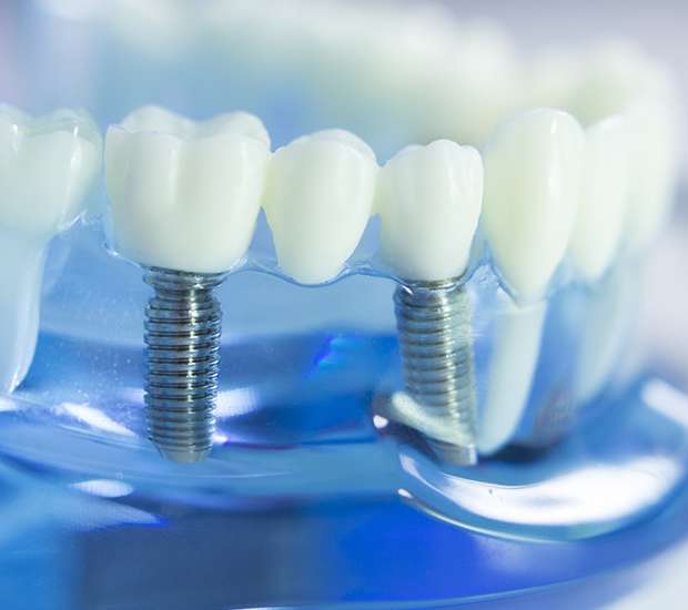 Parlin Dental Implants